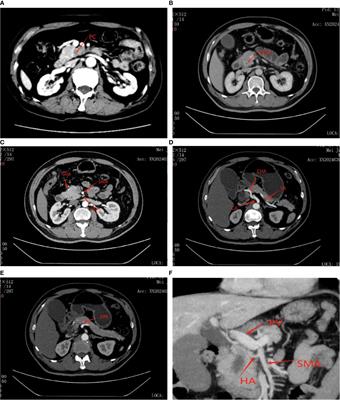 Causes and predictors of unplanned reoperations within 30 days post laparoscopic pancreaticoduodenectomy: a comprehensive analysis